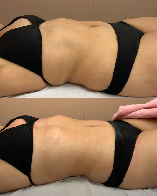 Formation Lipocavitation et Radiofréquence (machine non inclus)